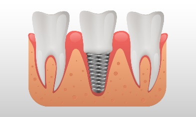 image2 Bridges Vs. dental implants